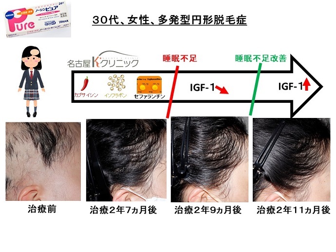 円形脱毛症　病院